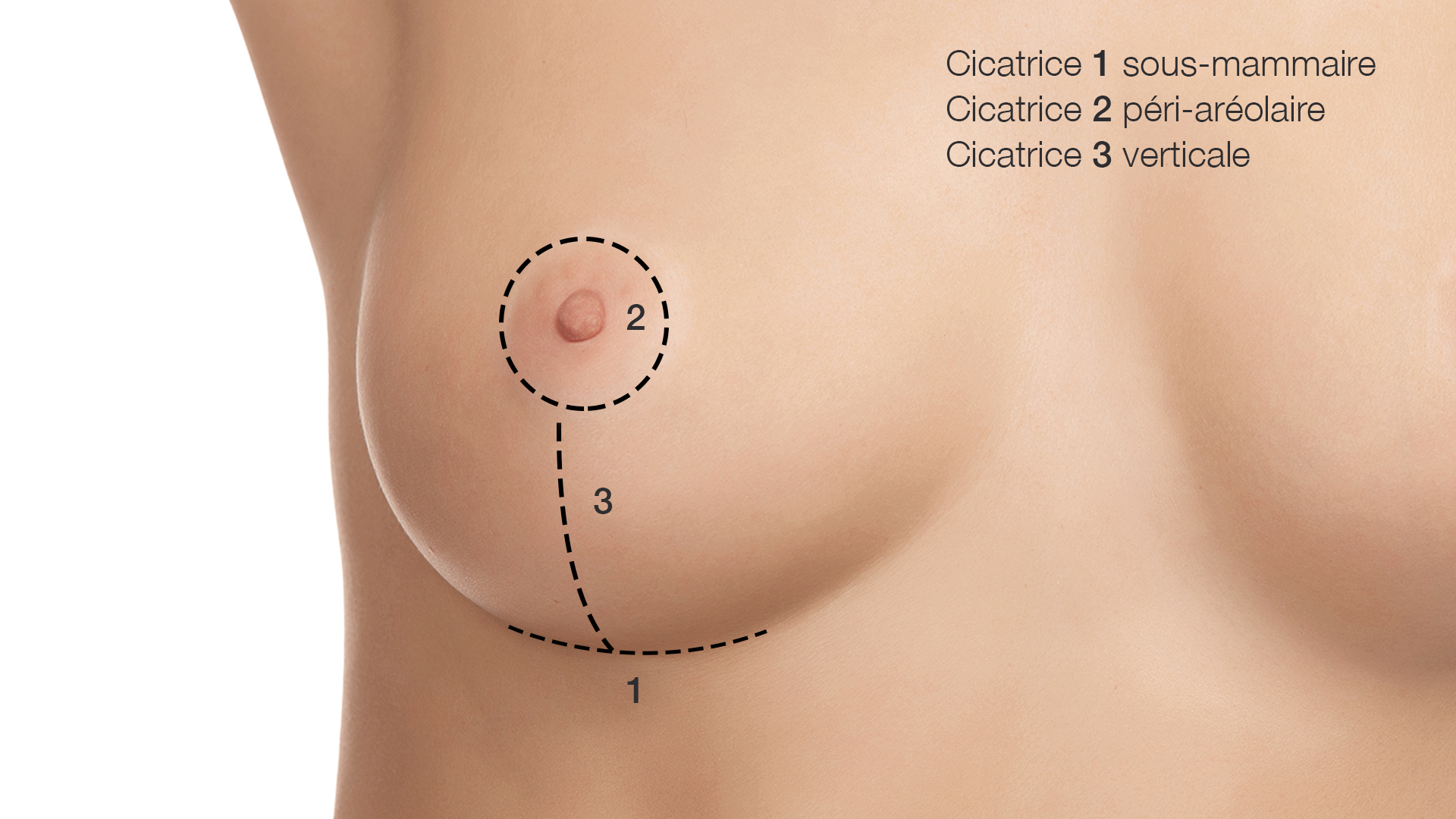 Ptose mammaire - Chirurgie Esthétique - Nice - Docteur Buffet